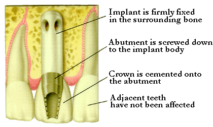 Anatomy of Dental Implant